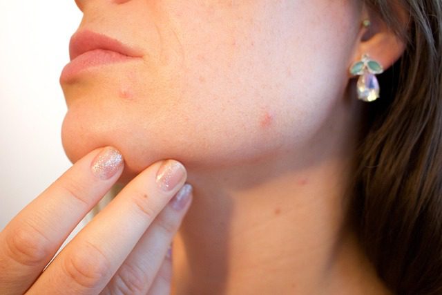 Acne free diet plan 30 days clearer skin results showing dramatic improvement in skin texture and breakouts